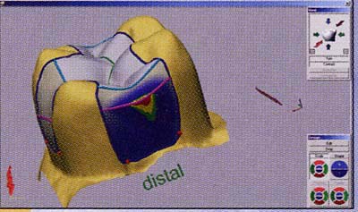 The Cerec Procedure