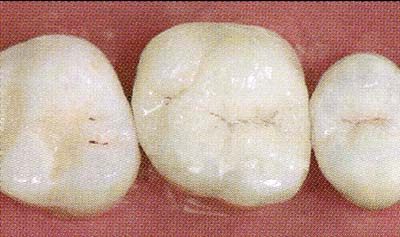 The Cerec Procedure