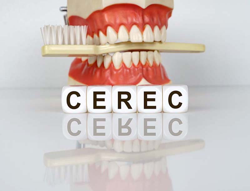 cerec picture