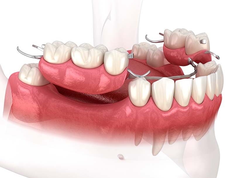 Dentures from Cathays Dental Practice, Cardiff