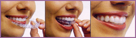 Invisible braces from invisalign
