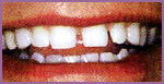 Spaces in teeth before Lumineers
