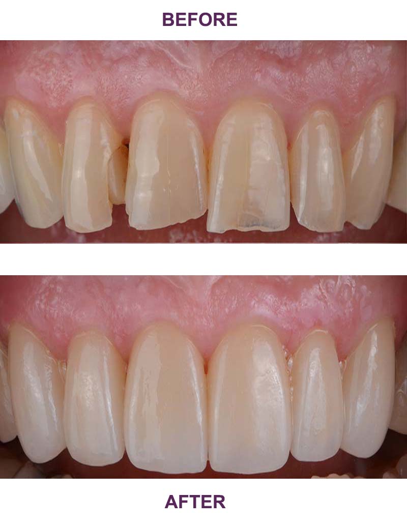 Teeth before and after Cosmetic contouring and Bonding