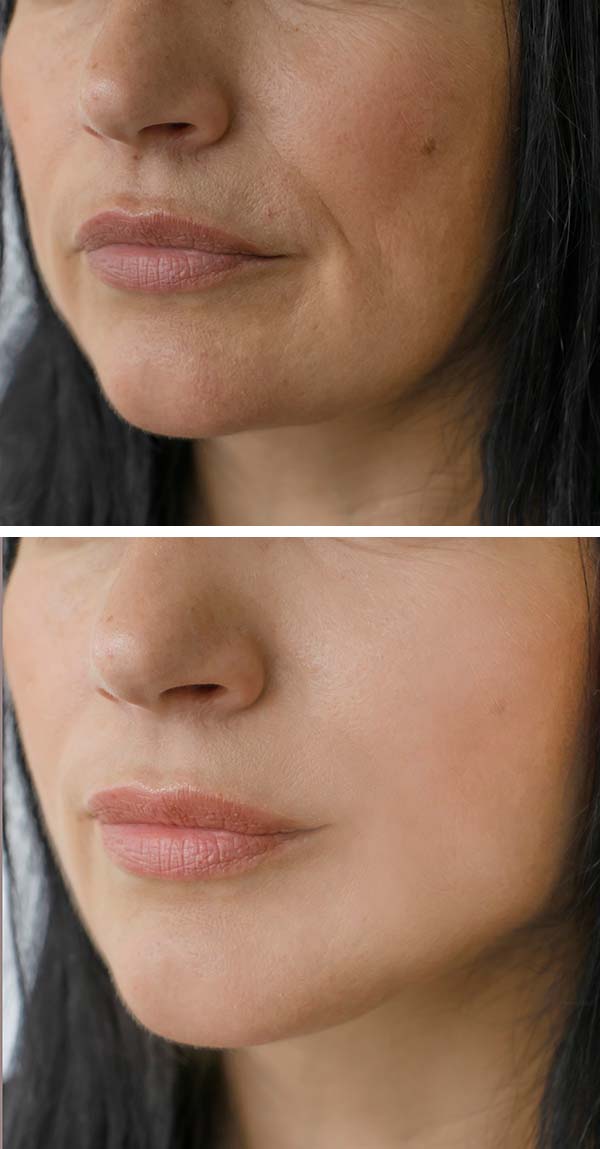 Picture showing Facial lines smoothening by Cathays Dental, Cardiff