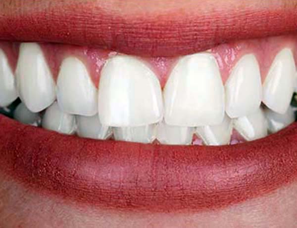 smile with Whitened teeth