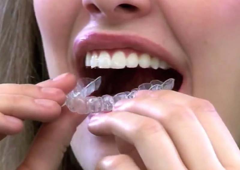 Invisalign Invisible Braces