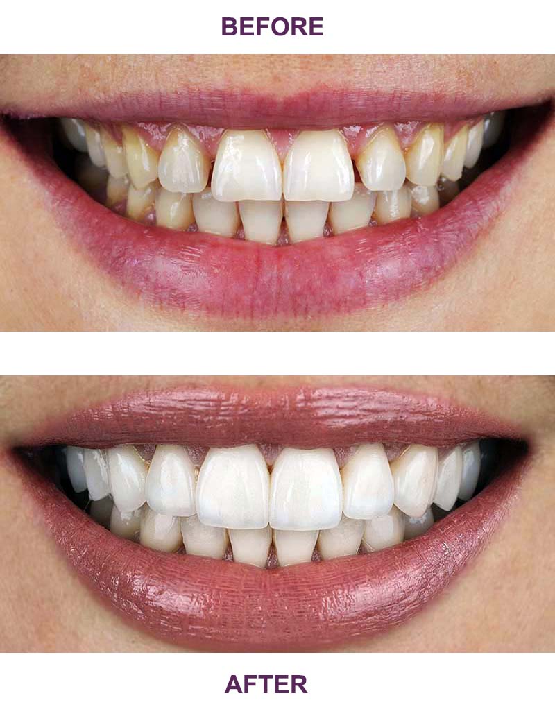 Teeth before and after Lumineers Treatment