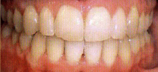 Invisaligned Teeth