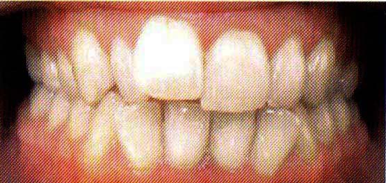 Crooked Teeth before Invisalign