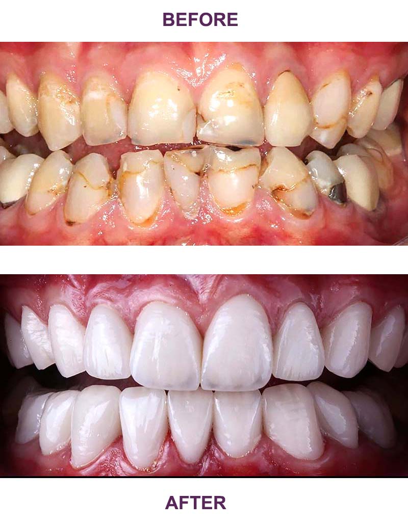 Teeth before and after Porcelain crowns