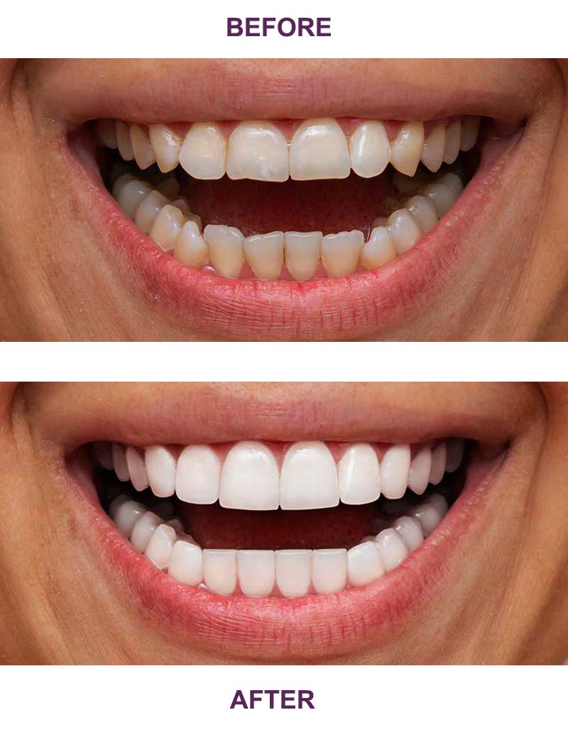 Teeth with veneers treatment