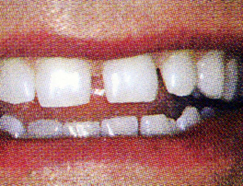 Teeth before Lumineers