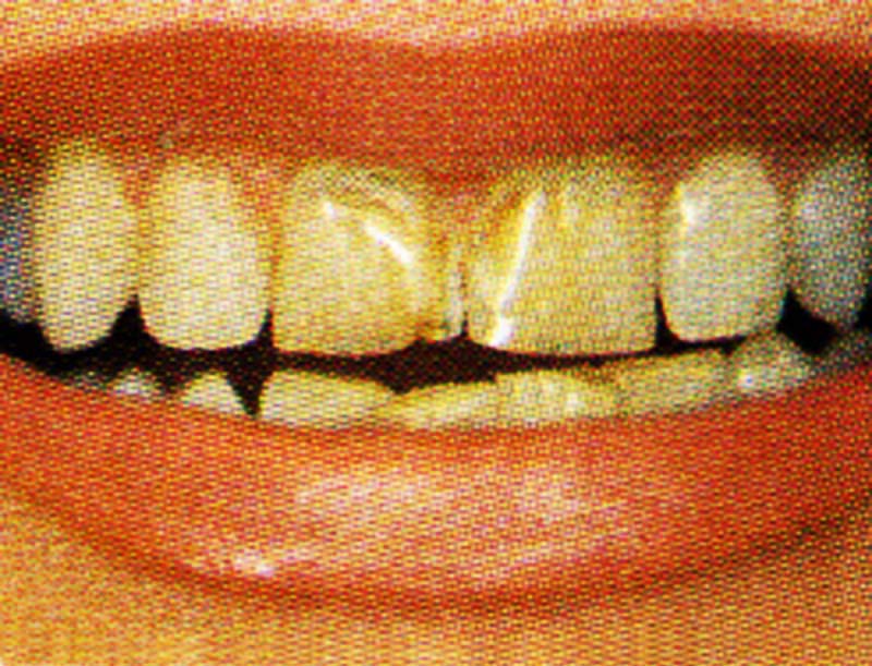 Teeth before Lumineers