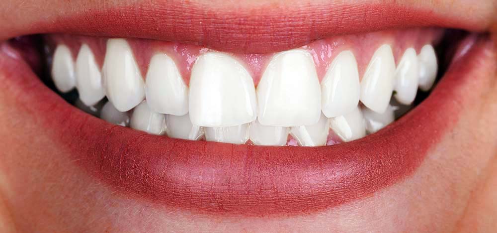 White Teeth after treatment