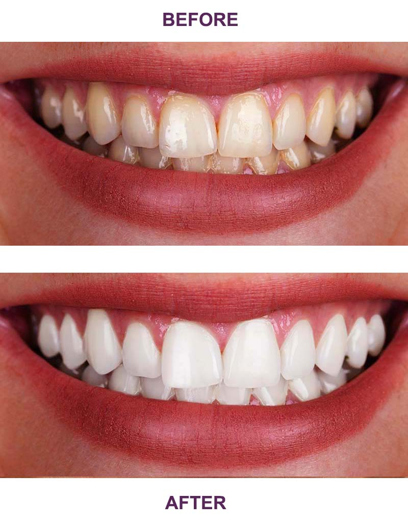 Results of Teeth whitening