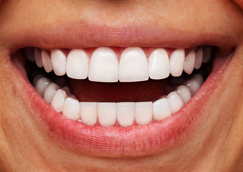 Porcelain Veneers