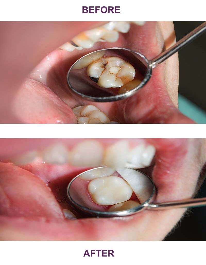 Teeth before and after White fillings Treatment